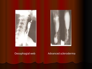 Dysphagia | PPTX