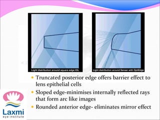  Truncated posterior edge offers barrier effect to
lens epithelial cells
 Sloped edge-minimises internally reflected rays
that form arc like images
 Rounded anterior edge- eliminates mirror effect
 
