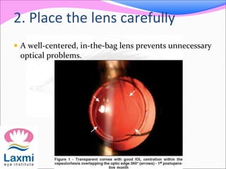 2. Place the lens carefully
 A well-centered, in-the-bag lens prevents unnecessary
optical problems.
 