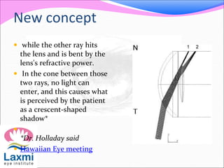 New concept
 while the other ray hits
the lens and is bent by the
lens's refractive power.
 In the cone between those
two rays, no light can
enter, and this causes what
is perceived by the patient
as a crescent-shaped
shadow*

*Dr. Holladay said
 Hawaiian Eye meeting
 