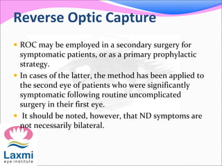 Reverse Optic Capture
 ROC may be employed in a secondary surgery for
symptomatic patients, or as a primary prophylactic
strategy.
 In cases of the latter, the method has been applied to
the second eye of patients who were significantly
symptomatic following routine uncomplicated
surgery in their first eye.
 It should be noted, however, that ND symptoms are
not necessarily bilateral.
 