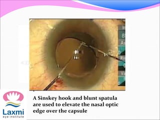 .
A Sinskey hook and blunt spatula
are used to elevate the nasal optic
edge over the capsule
 