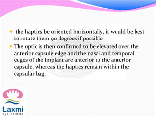  the haptics be oriented horizontally, it would be best
to rotate them 90 degrees if possible
 The optic is then confirmed to be elevated over the
anterior capsule edge and the nasal and temporal
edges of the implant are anterior to the anterior
capsule, whereas the haptics remain within the
capsular bag.
 