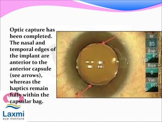Optic capture has
been completed.
The nasal and
temporal edges of
the implant are
anterior to the
anterior capsule
(see arrows),
whereas the
haptics remain
fully within the
capsular bag.
 