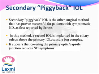 Secondary “Piggyback” IOL
 Secondary “piggyback” IOL is the other surgical method
that has proven successful for patients with symptomatic
ND, as first reported by Ernest.
 In this method, a second IOL is implanted in the ciliary
sulcus above the primary IOL/capsule bag complex.
 It appears that covering the primary optic/capsule
junction reduces ND symptoms
 