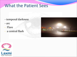 What the Patient Sees
- temporal darkness
- arc
- Flare
- a central flash
 