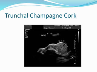 Trunchal Champagne Cork
 