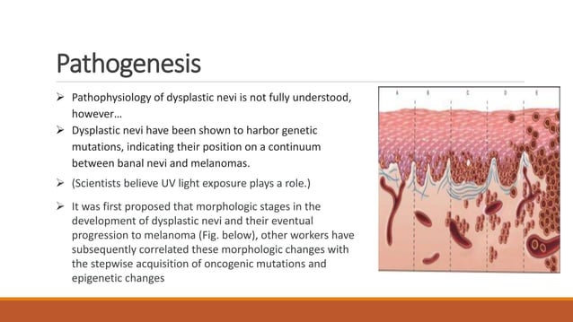 Dysplastic Incus Dysplastic and Melanocytic Naevi .pptx