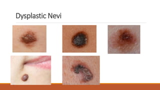 Dysplastic Incus Dysplastic and Melanocytic Naevi .pptx