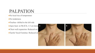 PALPATION
●No local rise of temperature
●No tenderness
●Trachea- shifted to the left side
●Apex beat- in 9th ICS, 1.5 cm lateral to MCL
●Chest wall expansion- Reduced on the right side
●Tactile Vocal Fremitus- Reduced on the right side
 