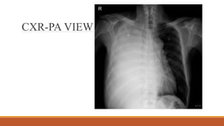 CXR-PA VIEW
 