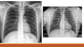 NORMAL CXR-PA VIEW
 