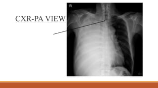 CXR-PA VIEW
 