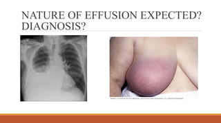 NATURE OF EFFUSION EXPECTED?
DIAGNOSIS?
 