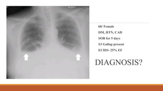 DIAGNOSIS?
60/ Female
DM, HTN, CAD
SOB for 5 days
S3 Gallop present
ECHO- 25% EF
 