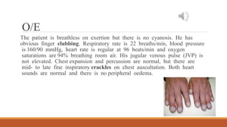 O/E
The patient is breathless on exertion but there is no cyanosis. He has
obvious finger clubbing. Respiratory rate is 22 breaths/min, blood pressure
is 160/90 mmHg, heart rate is regular at 96 beats/min and oxygen
saturations are 94% breathing room air. His jugular venous pulse (JVP) is
not elevated. Chest expansion and percussion are normal, but there are
mid- to late fine inspiratory crackles on chest auscultation. Both heart
sounds are normal and there is no peripheral oedema.
 