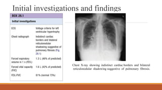 Initial investigations and findings
Chest X-ray showing indistinct cardiac borders and bilateral
reticulonodular shadowing suggestive of pulmonary fibrosis.
 