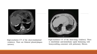 High-resolution CT of the chest (mediastinal
windows). There are bilateral pleural plaques
(arrows).
High-resolution CT of the chest (lung windows). There
is interlobular and intralobular septal thickening with
honeycombing, consistent with pulmonary fibrosis.
 
