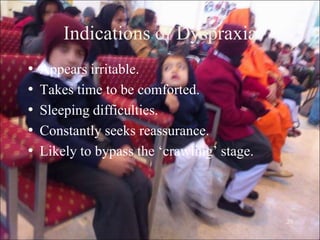 20
Indications of Dyspraxia
• Appears irritable.
• Takes time to be comforted.
• Sleeping difficulties.
• Constantly seeks reassurance.
• Likely to bypass the „crawling‟ stage.
 