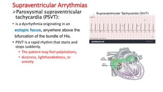 Dysrhythmia [Autosaved].pptx