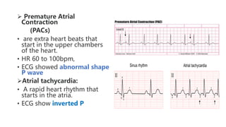 Dysrhythmia [Autosaved].pptx