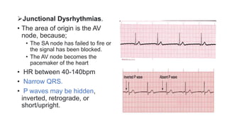 Dysrhythmia [Autosaved].pptx