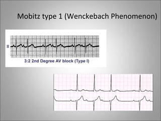 Mobitz type 1 (Wenckebach Phenomenon)
 