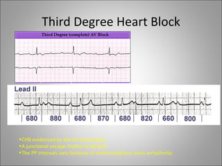 Third Degree Heart Block




•CHB evidenced by the AV dissociation
•A junctional escape rhythm at 45 bpm.
•The PP intervals vary because of ventriculophasic sinus arrhythmia;
 