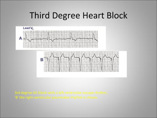 Third Degree Heart Block




3rd degree AV block with a left ventricular escape rhythm,
'B' the right ventricular pacemaker rhythm is shown.
 