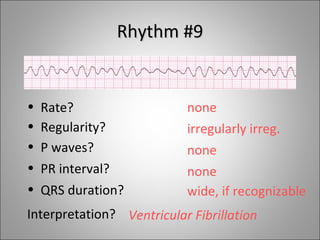 Rhythm #9


•   Rate?                  none
•   Regularity?            irregularly irreg.
•   P waves?               none
•   PR interval?           none
• QRS duration?            wide, if recognizable
Interpretation? Ventricular Fibrillation
 