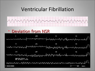Ventricular Fibrillation


• Deviation from NSR
  – Completely abnormal.
 