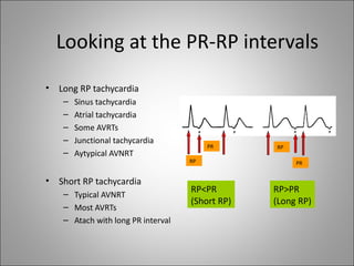 Looking at the PR-RP intervals
•   Long RP tachycardia
     –   Sinus tachycardia
     –   Atrial tachycardia
     –   Some AVRTs
     –   Junctional tachycardia
                                          PR      RP
     –   Aytypical AVNRT
                                     RP                PR


•   Short RP tachycardia
     – Typical AVNRT
                                     RP<PR        RP>PR
                                     (Short RP)   (Long RP)
     – Most AVRTs
     – Atach with long PR interval
 