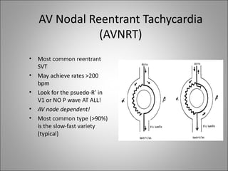 AV Nodal Reentrant Tachycardia
               (AVNRT)
•   Most common reentrant
    SVT
•   May achieve rates >200
    bpm
•   Look for the psuedo-R’ in
    V1 or NO P wave AT ALL!
•   AV node dependent!
•   Most common type (>90%)
    is the slow-fast variety
    (typical)
 