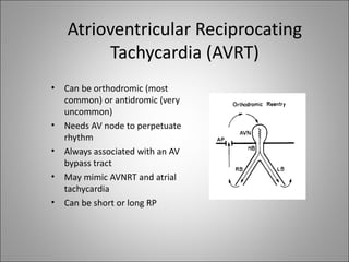 Atrioventricular Reciprocating
         Tachycardia (AVRT)
•   Can be orthodromic (most
    common) or antidromic (very
    uncommon)
•   Needs AV node to perpetuate
    rhythm
•   Always associated with an AV
    bypass tract
•   May mimic AVNRT and atrial
    tachycardia
•   Can be short or long RP
 