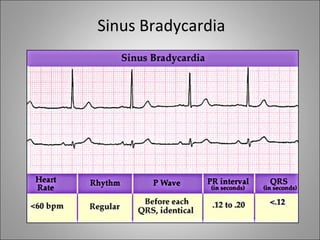 Sinus Bradycardia
 