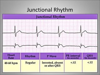 Junctional Rhythm
 