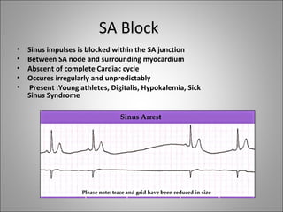 SA Block
•   Sinus impulses is blocked within the SA junction
•   Between SA node and surrounding myocardium
•   Abscent of complete Cardiac cycle
•   Occures irregularly and unpredictably
•   Present :Young athletes, Digitalis, Hypokalemia, Sick
    Sinus Syndrome
 