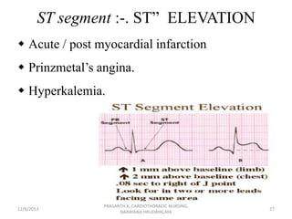 Segmen St Dysrrhythmia, major arrhythmias and management, bascs of ECG. | PPSX