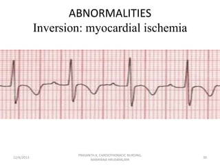 Dysrrhythmia, major arrhythmias and management, bascs of ECG. | PPSX