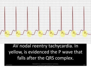 AV nodal reentry tachycardia. In
yellow, is evidenced the P wave that
falls after the QRS complex.
12/6/2013

PRASANTH.K, ...