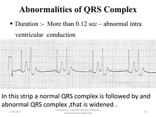 Abnormalities of QRS Complex
 Duration :- More than 0.12 sec – abnormal intra
ventricular conduction

In this strip a nor...