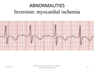ABNORMALITIES
Inversion: myocardial ischemia

12/6/2013

PRASANTH.K, CARDIOTHORACIC NURSING,
NARAYANA HRUDAYALAYA

30

 