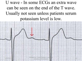 U wave - In some ECGs an extra wave
can be seen on the end of the T wave.
Usually not seen unless patients serum
potassium...