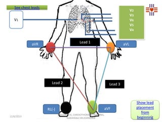 See chest leads

V2
V3
V6
V5
V4

V1

Lead 1

aVR

aVL

Lead 2

RL(-)
12/6/2013

Lead 3

aVF
PRASANTH.K, CARDIOTHORACIC NUR...