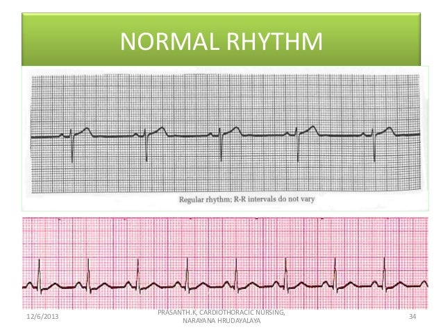 Dysrrhythmia, major arrhythmias and management, bascs of ECG.