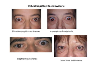 Rétrac2on	
  paupières	
  supérieures	
   Asynergie	
  oculopalpébrale	
  
Exophtalmie	
  unilatérale	
  
Ophtalmopathie	
  Basedowienne	
  
Exophtalmie	
  oedémateuse	
  
 