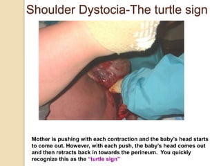 Shoulder Dystocia-The turtle sign
Mother is pushing with each contraction and the baby’s head starts
to come out. However, with each push, the baby’s head comes out
and then retracts back in towards the perineum. You quickly
recognize this as the “turtle sign”
 