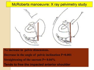 No increase in pelvic dimensions.
Decrease in the angle of pelvic inclination P=0.001
Straightening of the sacrum P= 0.04%
Tends to free the impacted anterior shoulder
McRoberts manoeuvre: X ray pelvimetry study
 