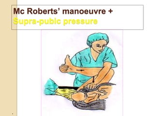 .
Mc Roberts’ manoeuvre +
Supra-pubic pressure
 