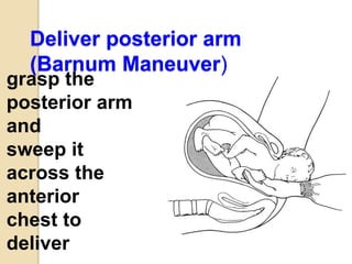 Deliver posterior arm
(Barnum Maneuver)
grasp the
posterior arm
and
sweep it
across the
anterior
chest to
deliver
 